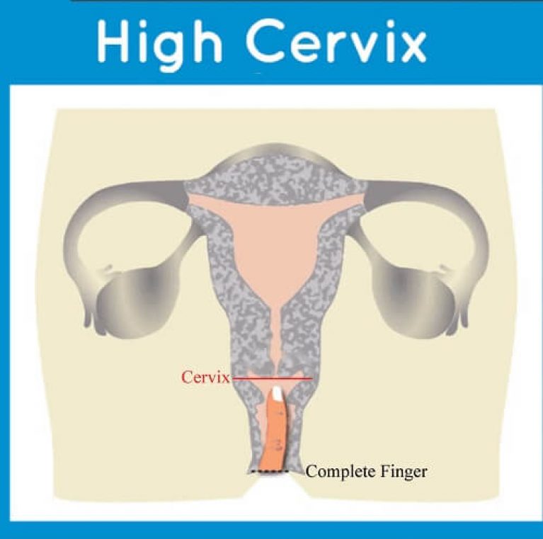 How to Choose Best Menstrual Cup for a Low Cervix and High Cervix
