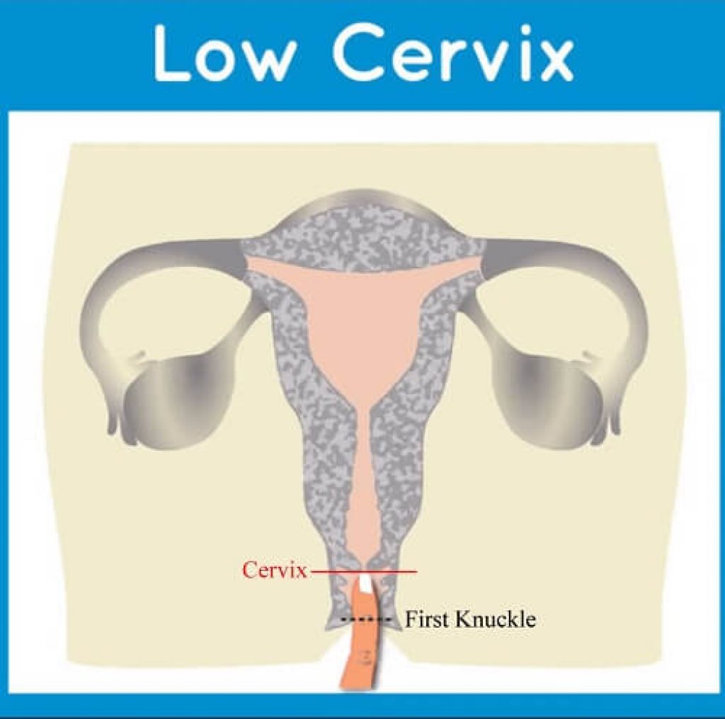 Low Cervix