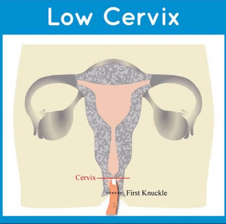 How to Choose Best Menstrual Cup for a Low Cervix and High Cervix