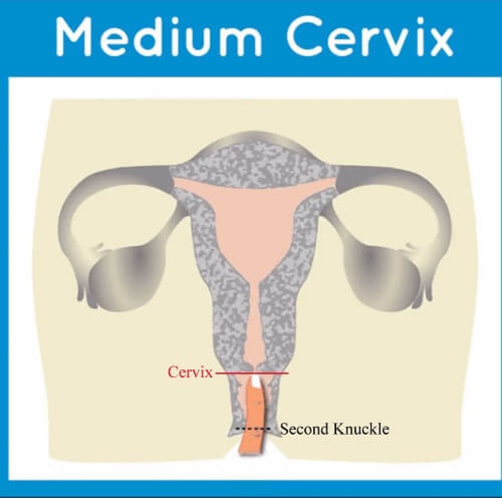 Average Or Medium Cervix 
