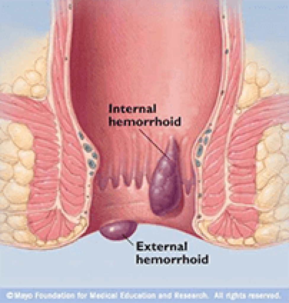  Sintomas de Hemorróidas