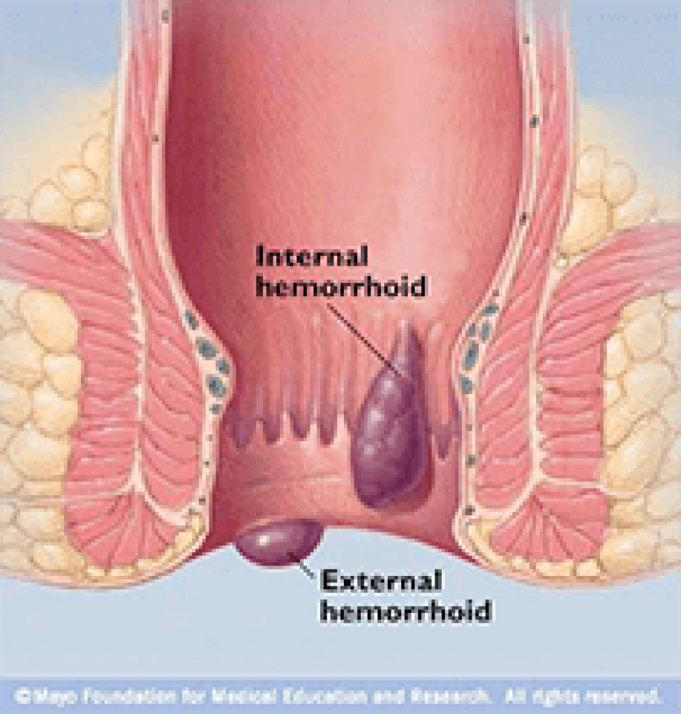 Why Hemorrhoid Pain Worse At Night