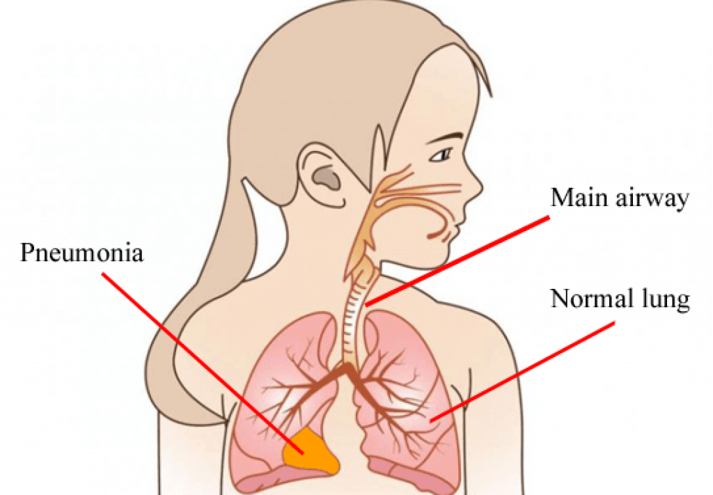 What Is Pneumonia