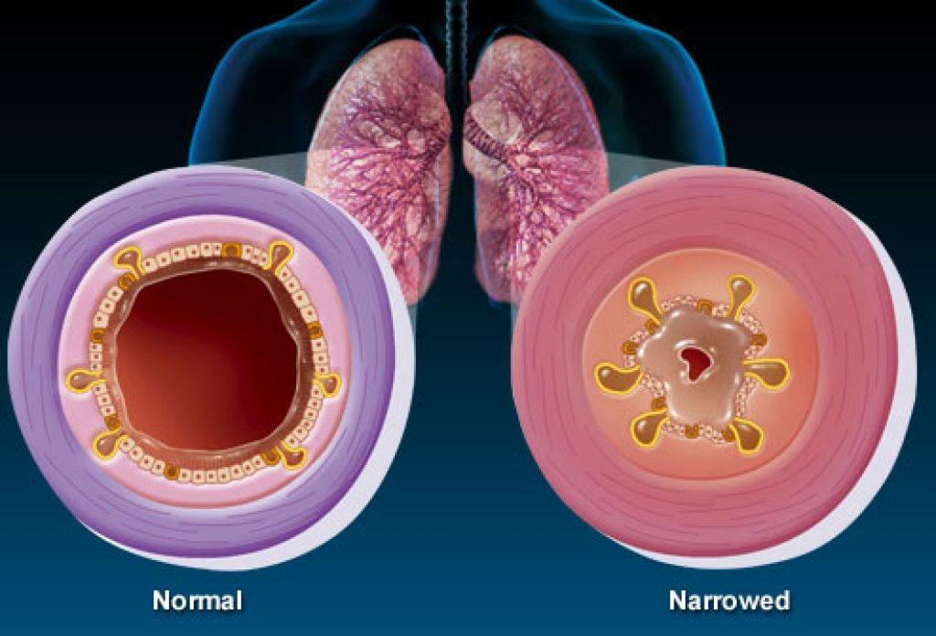 bronchitis vs pneumonia lung sounds