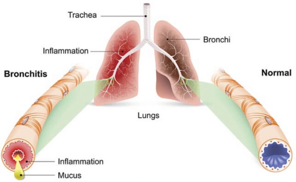 What Is Bronchiolitis 