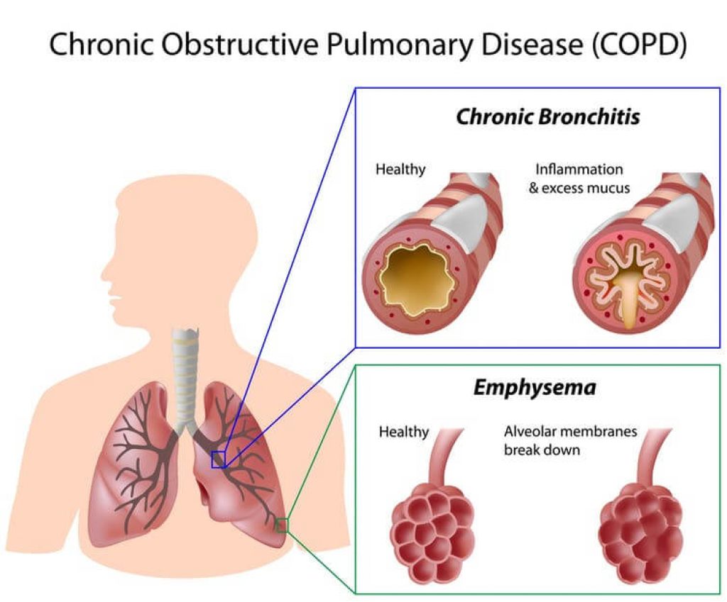 Copd-chronic Obstructive Pulmonary Disease