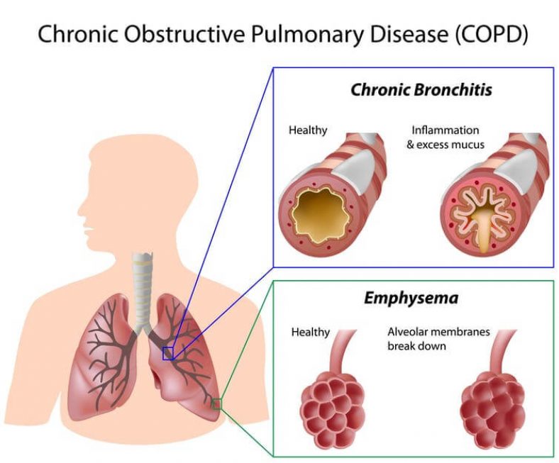 How to tell if Bronchitis is Turning into Pneumonia