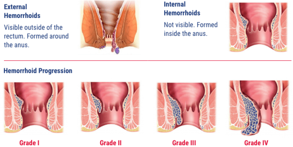 Severe Grades of Prolapsed Hemorrhoids