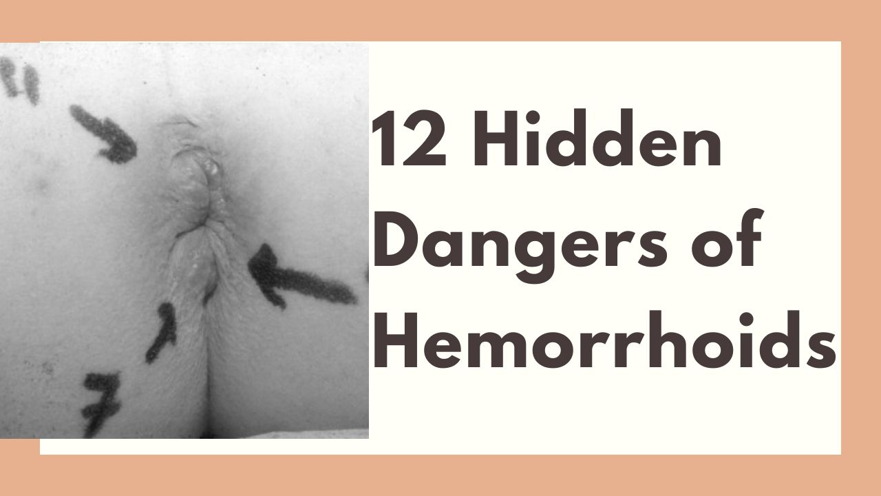 12 Hidden Dangers of Hemorrhoids