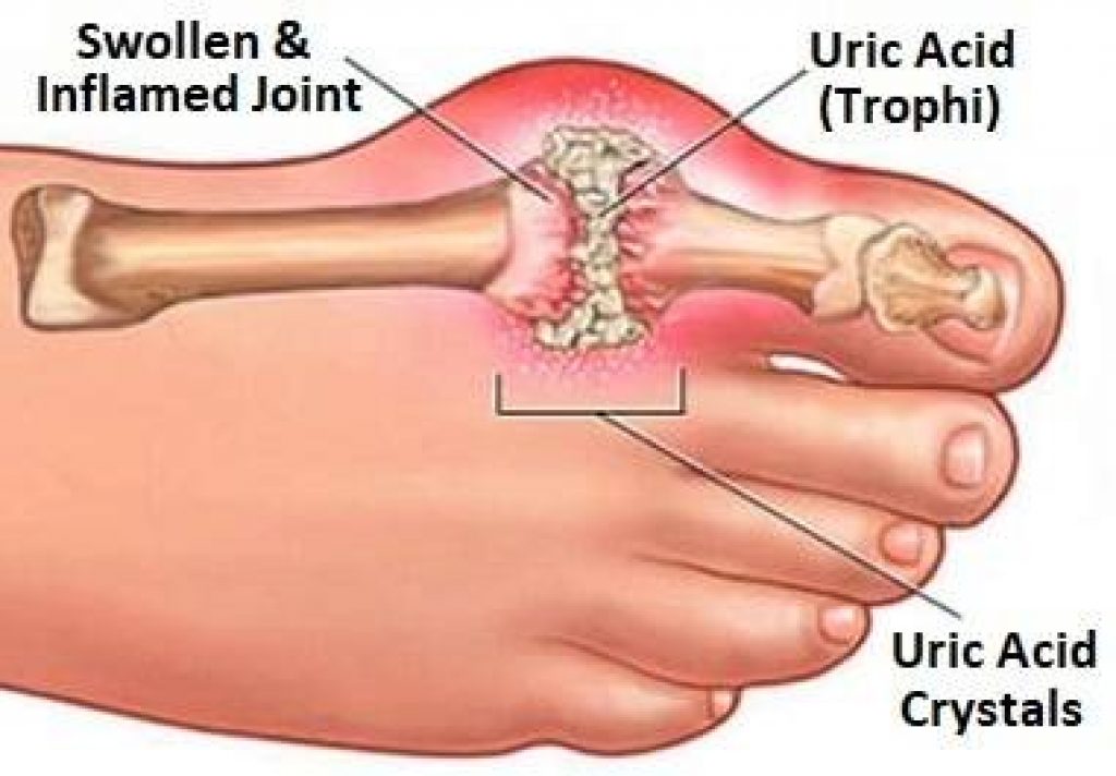 Gout Prevention Supplements