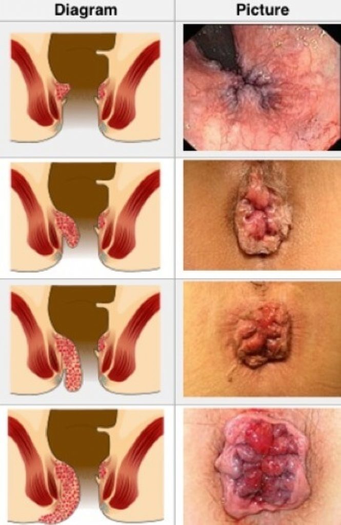 Why Hemorrhoid Pain Worse At Night