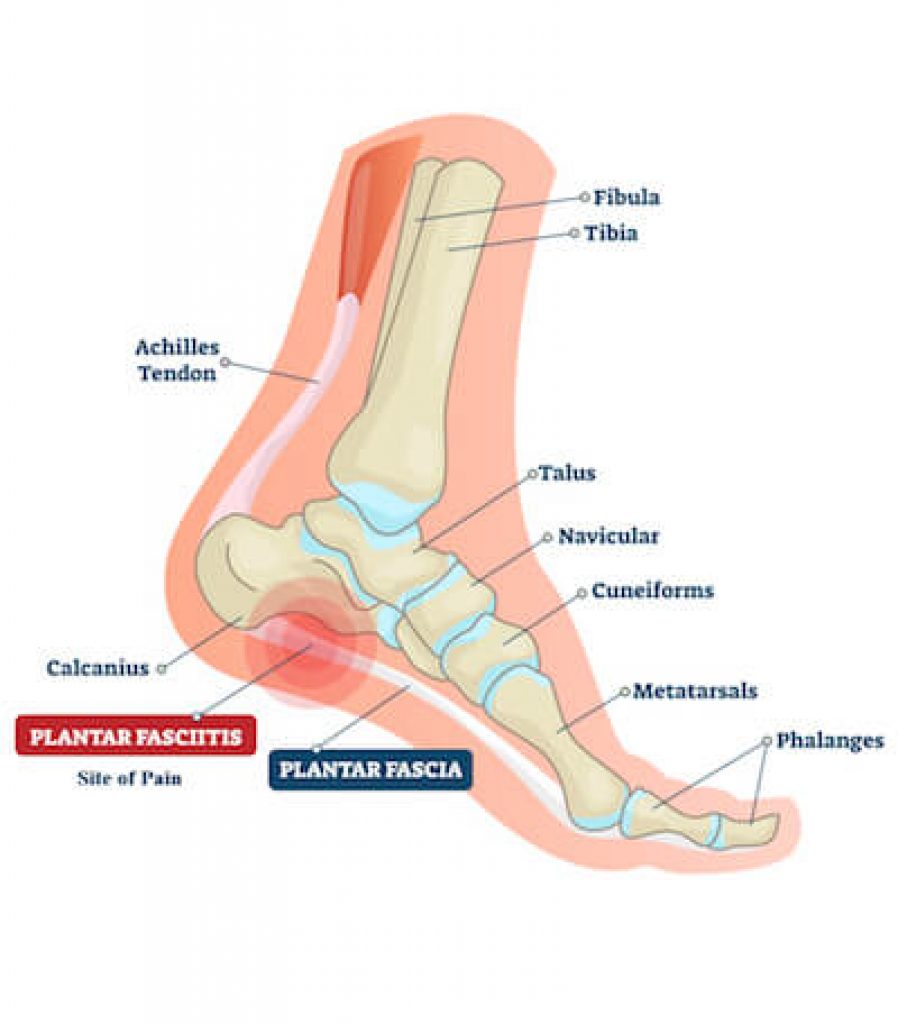 Plantar Fasciitis Pictures 