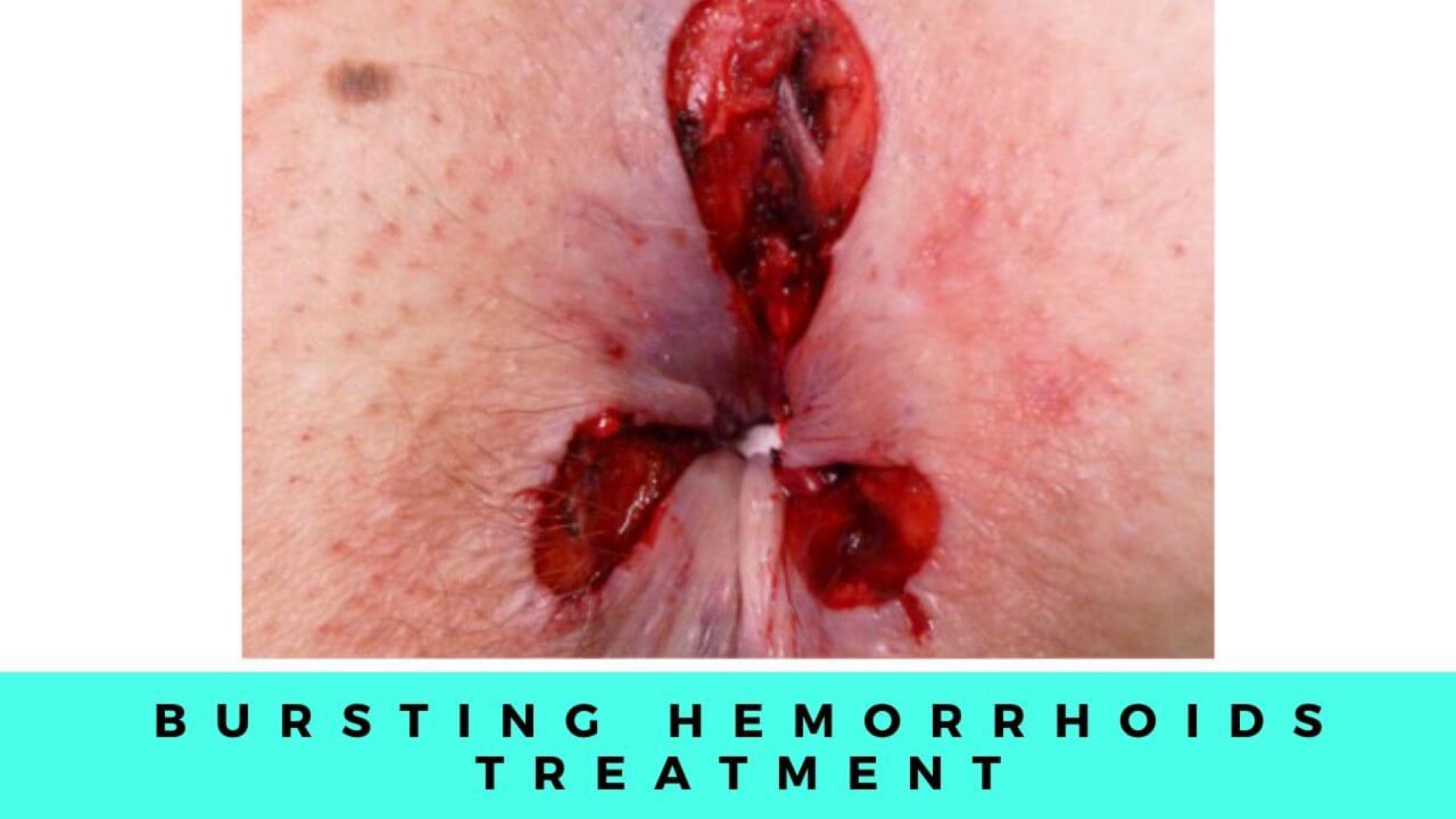 Hemorrhoids Bursting Treatment, Symptoms and Causes