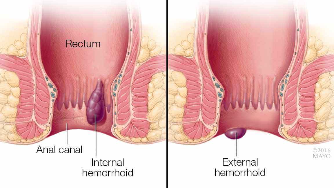 rectal cancer vs piles