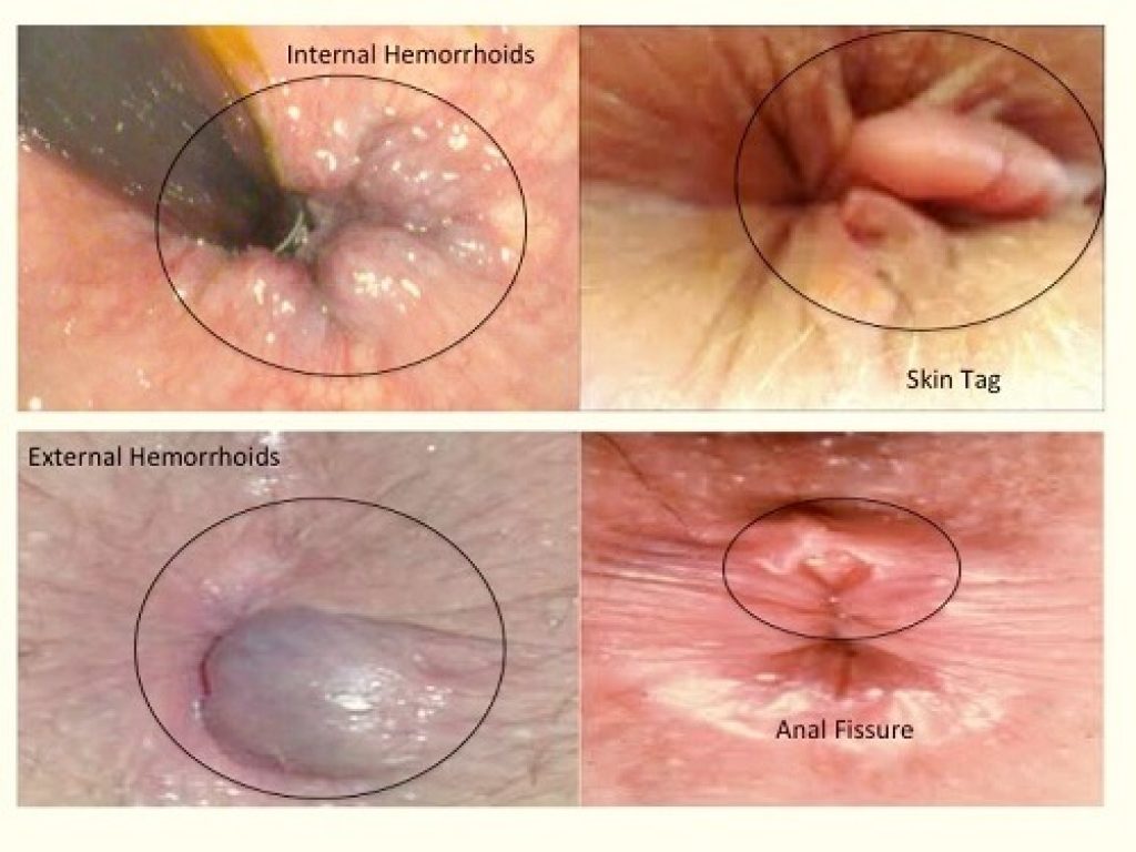 Piles Symptoms Pictures