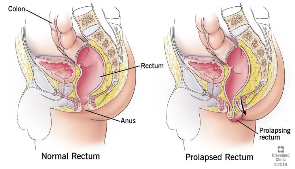 Prolapsed Hemorrhoids