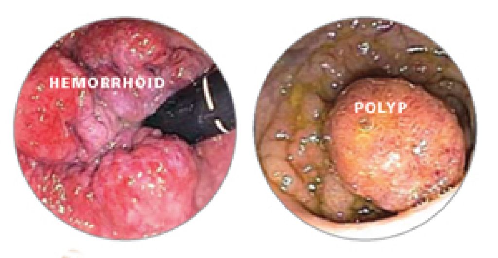 Ulcerated Hemorrhoids Pictures	