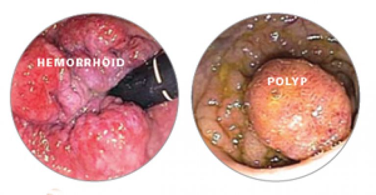 Hemorrhoids Pictures