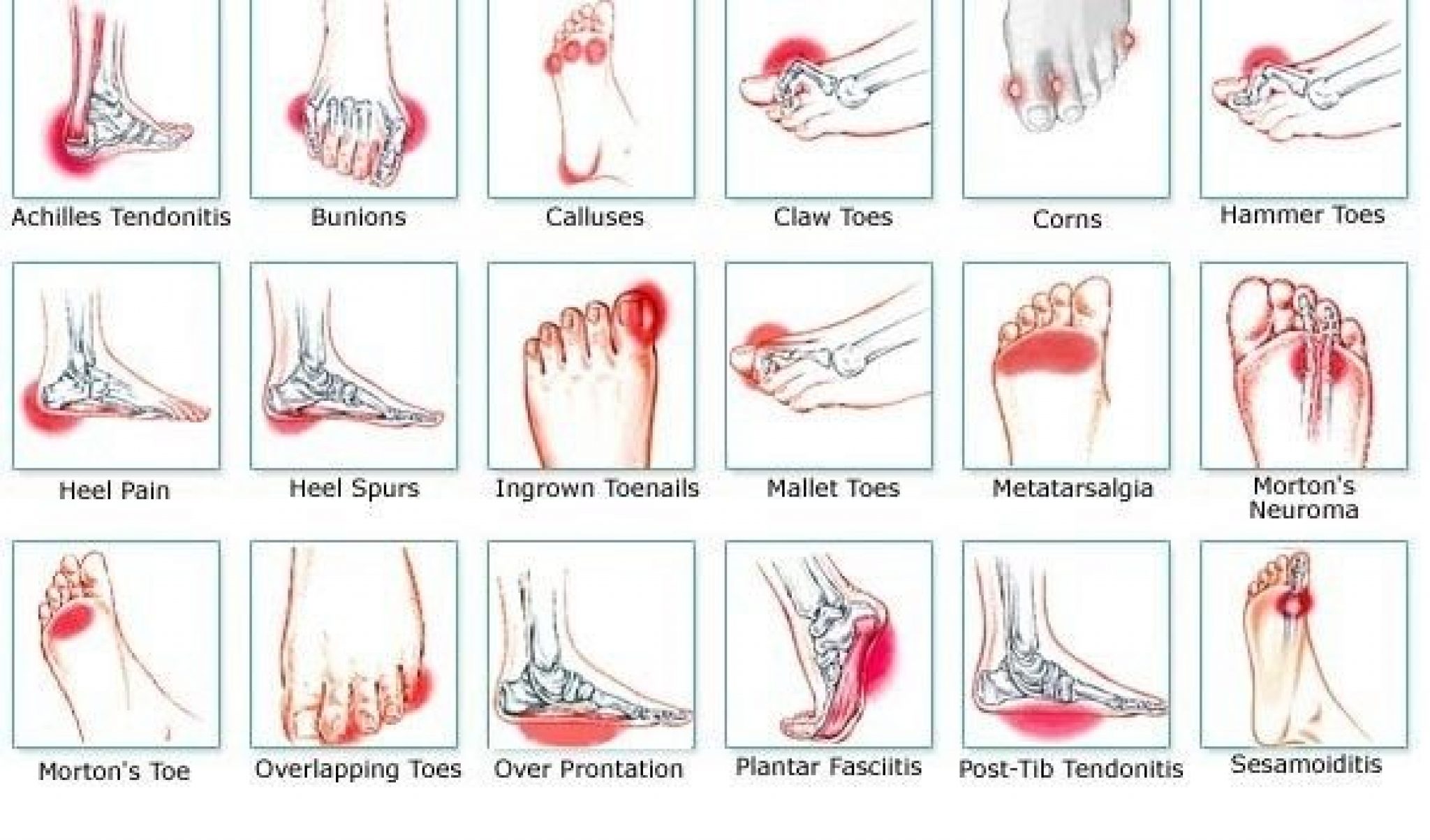 Bottom Foot Pain Identifier Chart