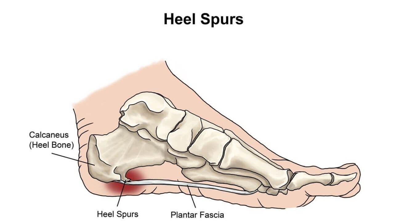 What is a heel spur