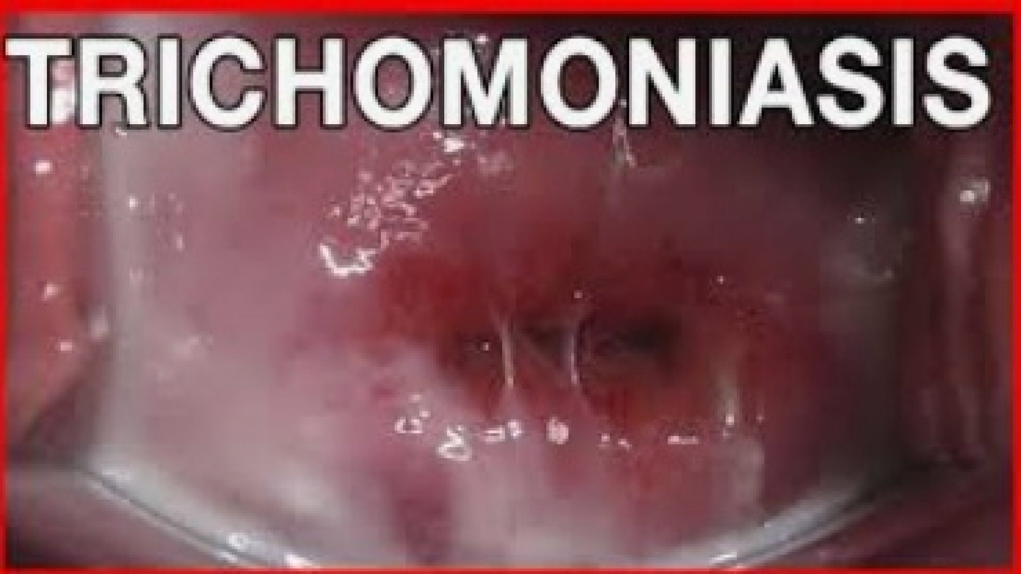 How Long Can TRICHOMONIASIS Be Dormant In A WOMAN